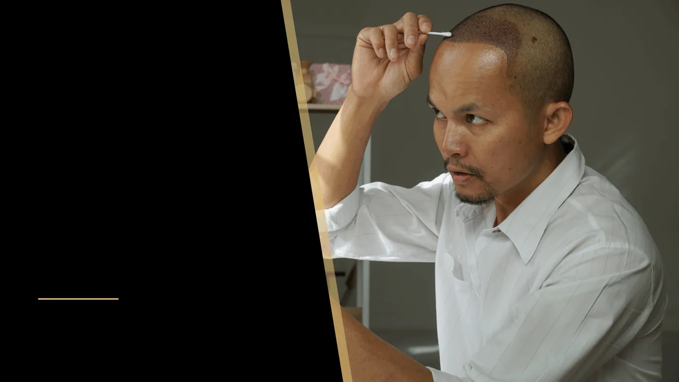What to Expect During a Hair Transplant Recovery