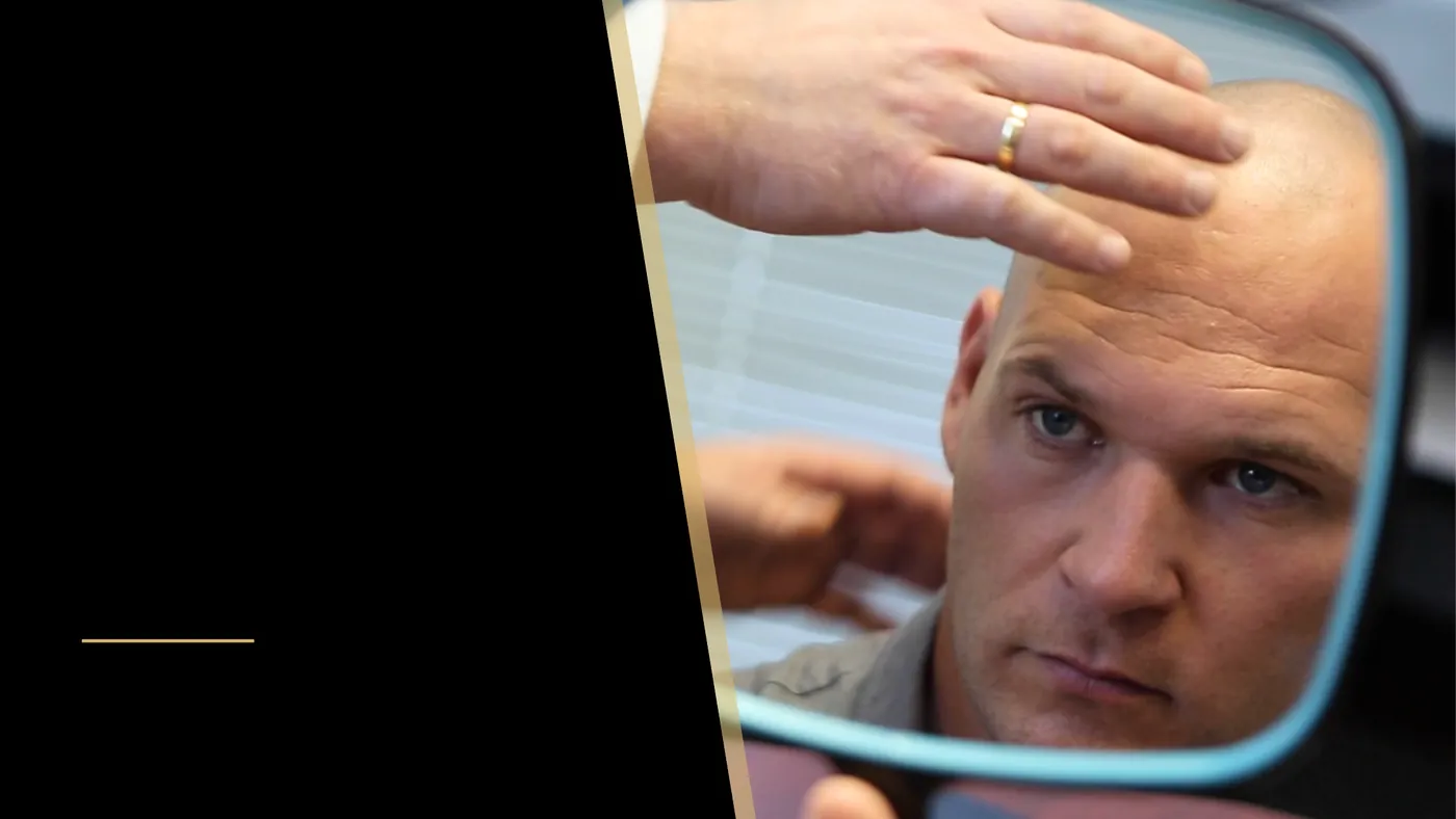 What Factors Affect the Cost of a Hair Transplant