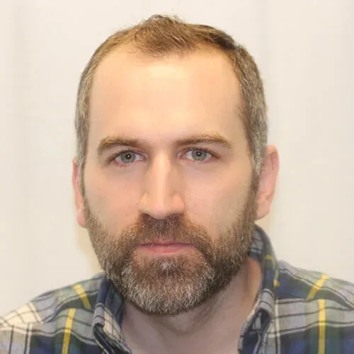 Drew J Before Hair Transplant photo