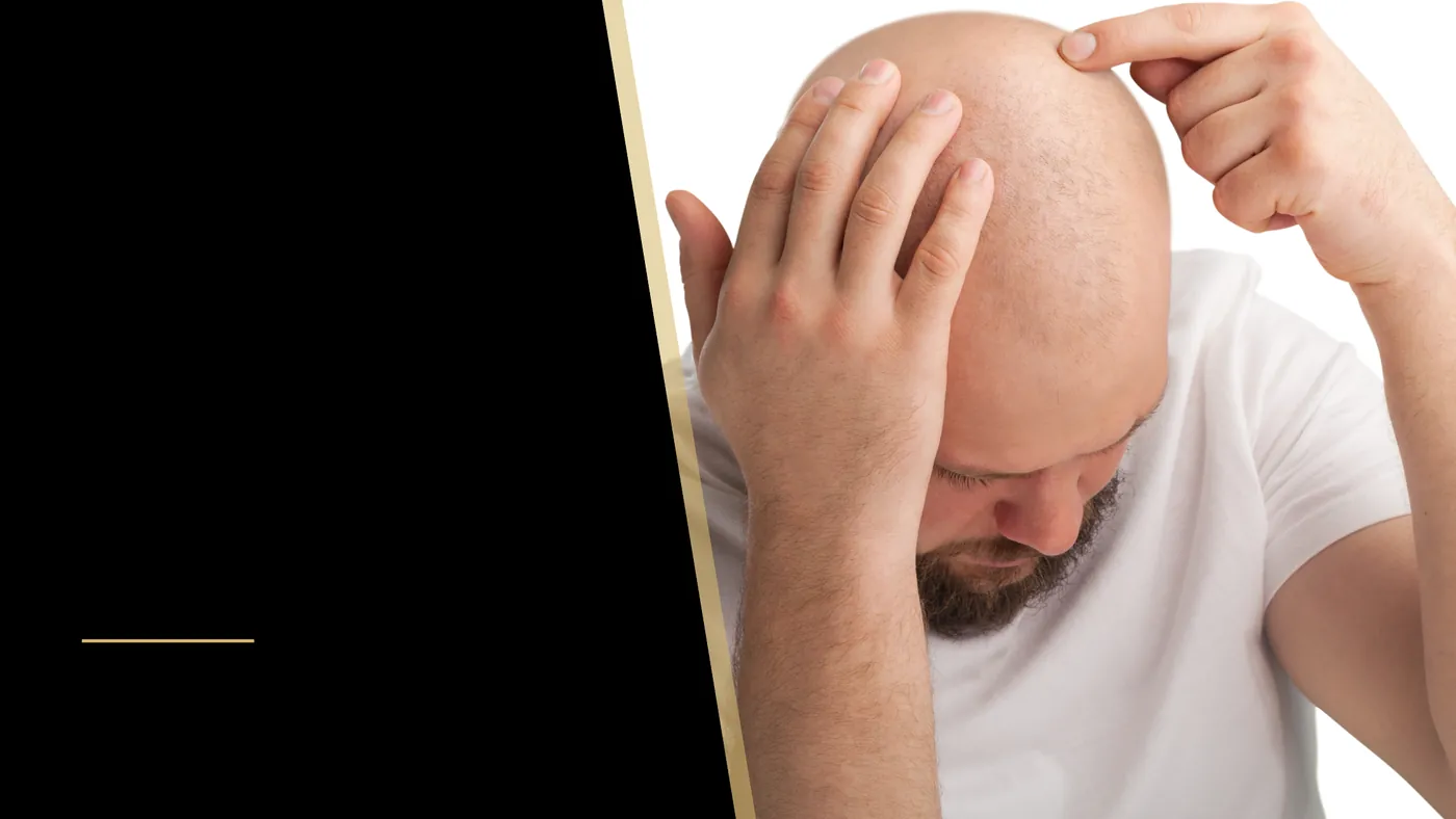 What is the Norwood Scale?