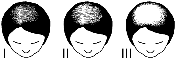 Ludwig scale of female pattern hair loss, types I to III