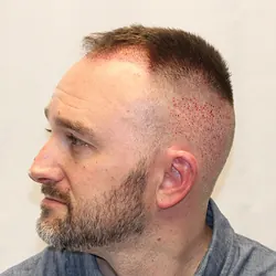 Client Daniel T. progress Day After