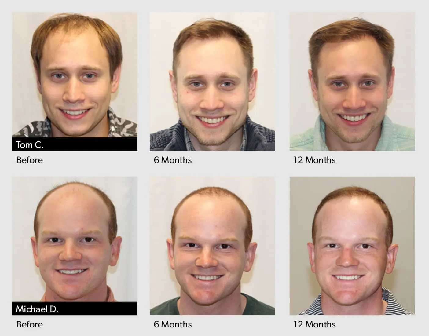 FUE Hair Transplant progress photos over 12 months