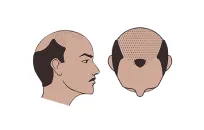 Norwood Class 6 hair loss illustration