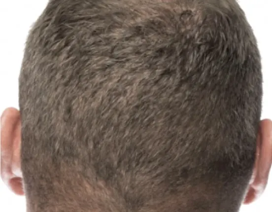 RESTORE FUE hair transplant method