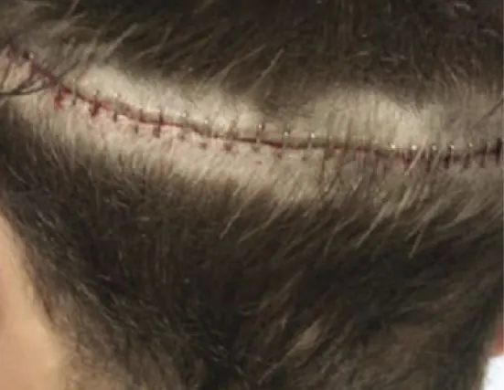 Old strip method hair transplant scar