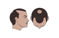 Norwood Class 3 hair loss illustration