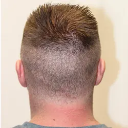 Client Daniel T. progress 5 Days After