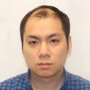 Tony L. before hair transplant