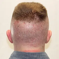 Client Daniel T. progress Day After