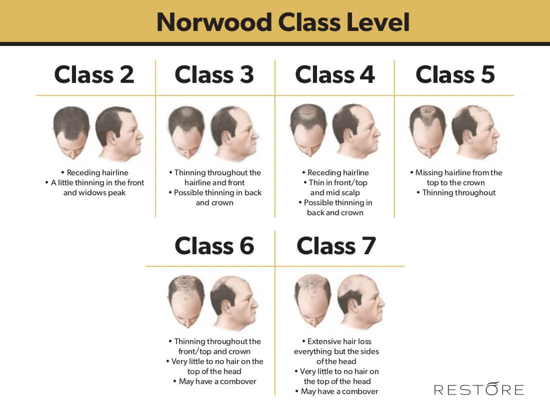 Norwood scale chart showing the stages of male pattern hair loss