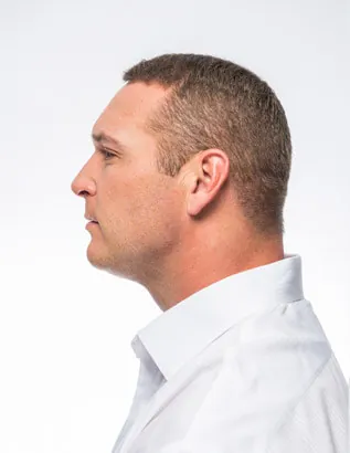 Brian Urlacher After Hair Transplant
