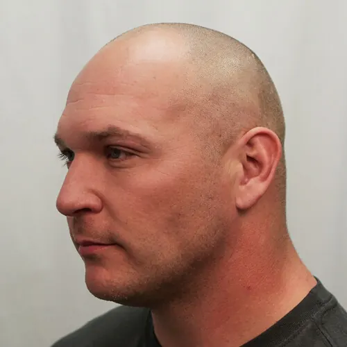 Brian Urlacher Before Hair Transplant