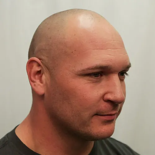 Brian Urlacher Before Hair Transplant