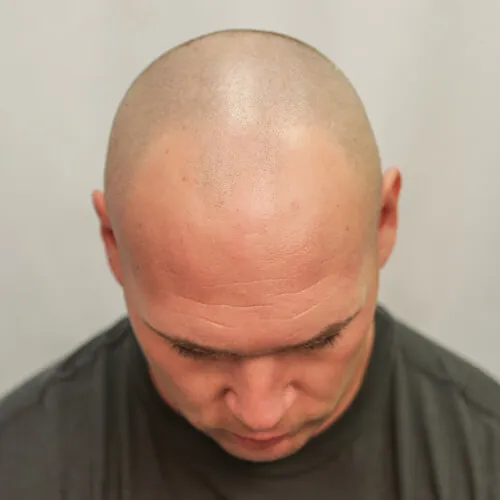 Brian Urlacher Before Hair Transplant