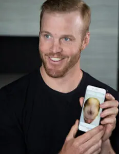 Bryan Bickell Before Hair Transplant