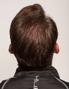 Kevin VanDam Hair Transplant