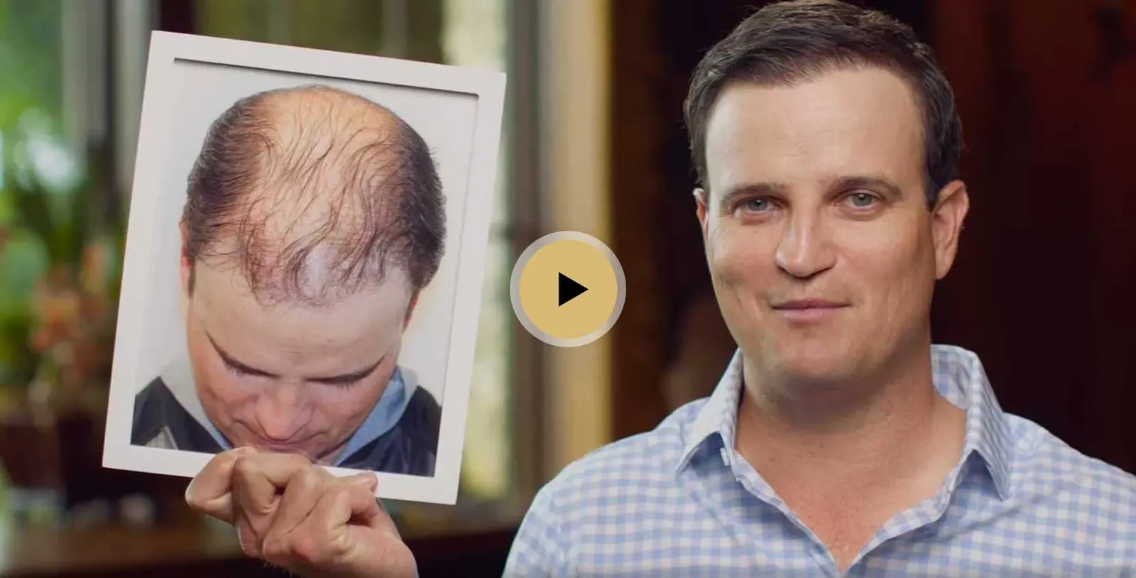Zach Johnson hair transplant story