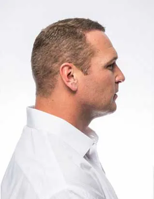 Brian Urlacher After Hair Transplant