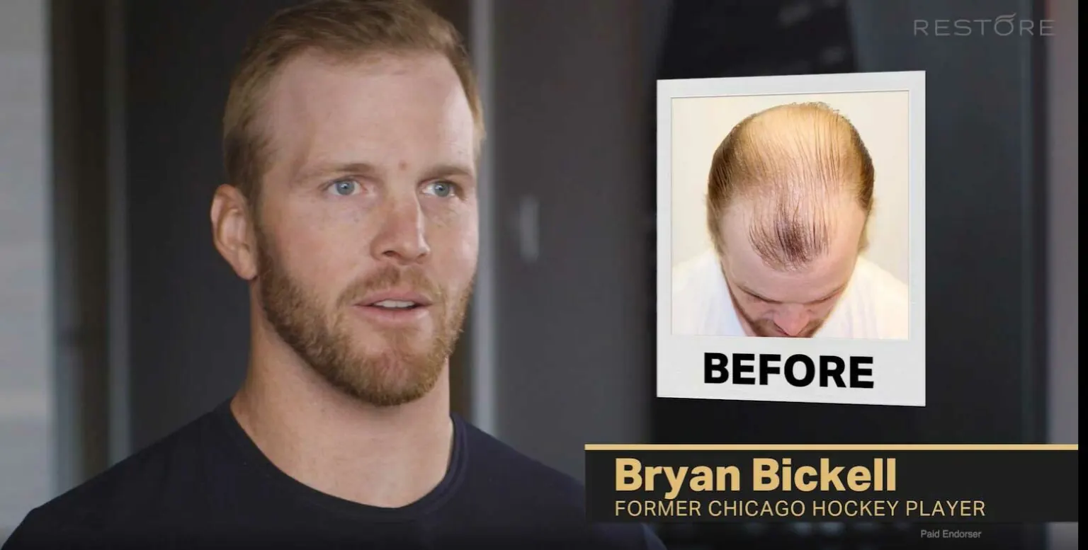 Bryan Bickell hair transplant story