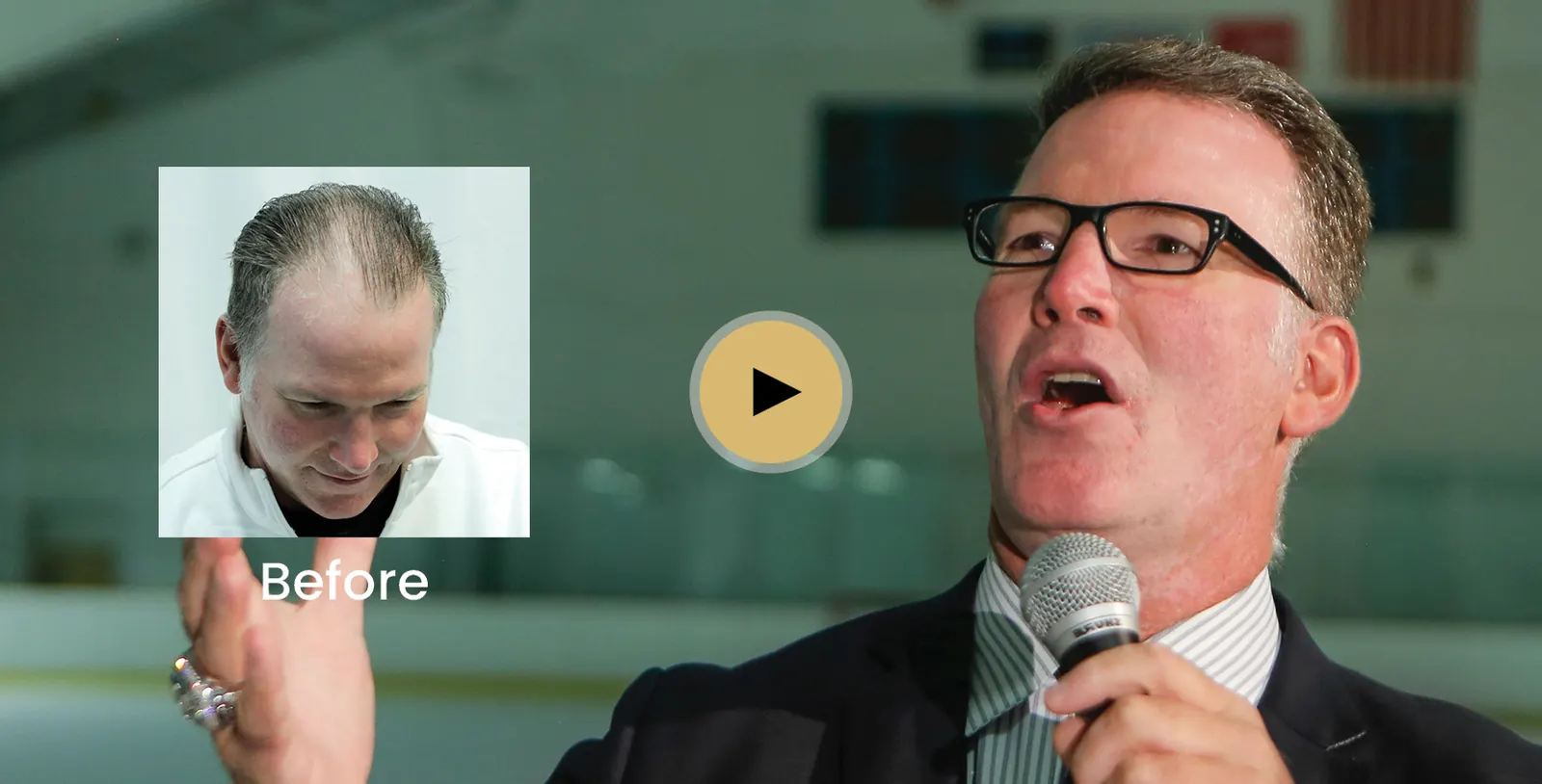 Jim Cornelison hair transplant story