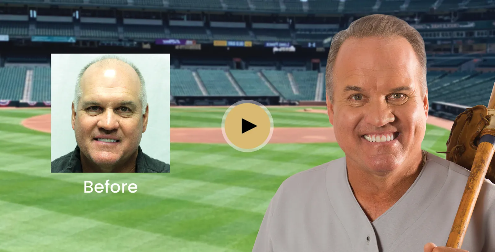 Ryne Sandberg hair transplant story