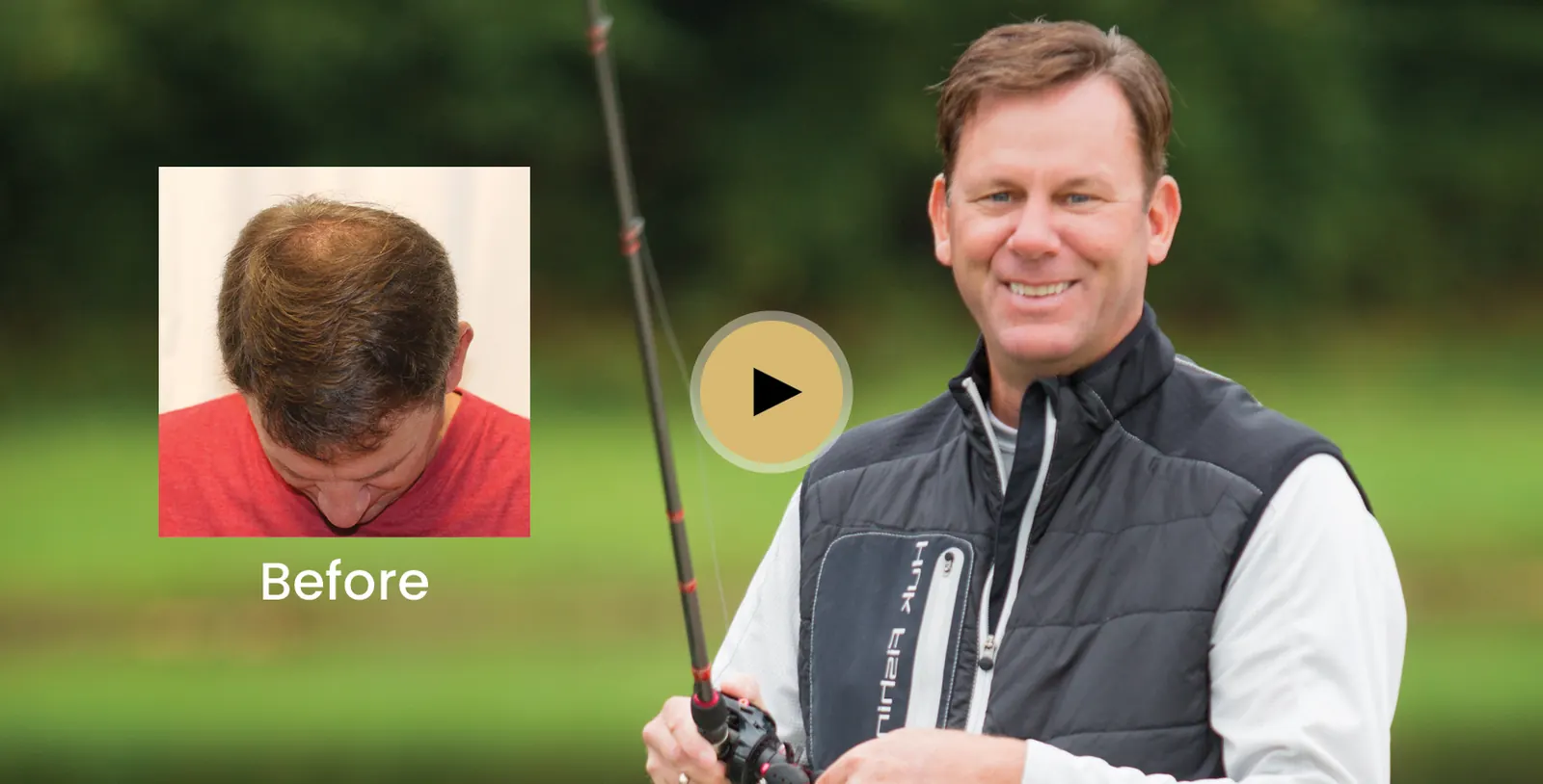 Kevin VanDam hair transplant story