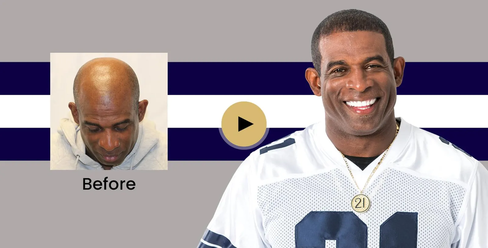 Deion Sanders hair transplant story