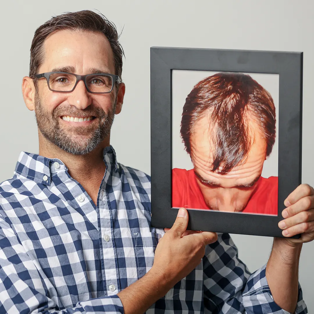 No-Shave F.U.E. Procedure