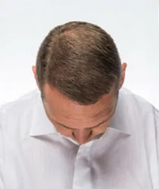 Brian Urlacher After Hair Transplant