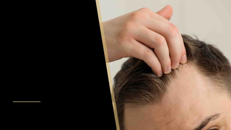 Hair Transplant for Receding Temples & Receding Hairline? 30 A man touching his hair