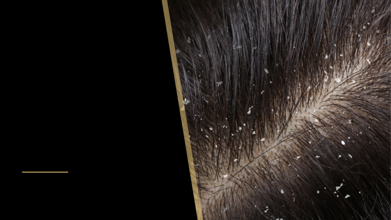 Can Dandruff Cause Hair Loss? 28 hair close up