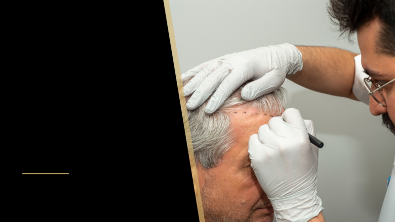 Life After a Hair Transplant 10 Doctor and a patient