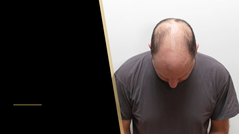 It’s not the Hair, it’s the Loss 6 Hair loss Blog