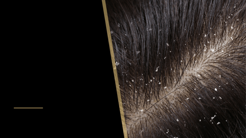 Can Dandruff Cause Hair Loss? 10 A picture of dandruff