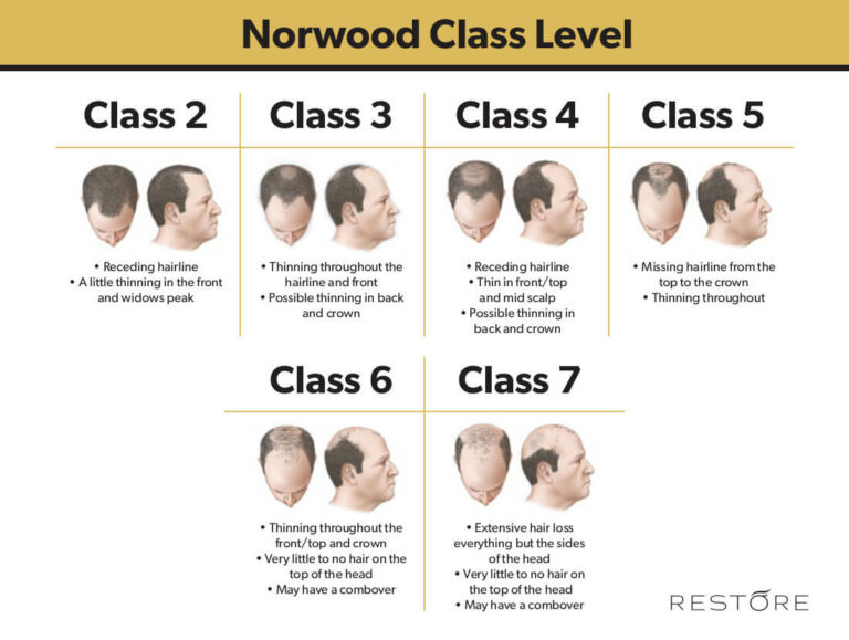 Norwood Scale for Balding Norwood Chart RESTORE Hair