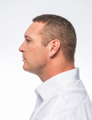 Brian Urlacher After Hair Transplant Brian Urlacher After Hair Transplant