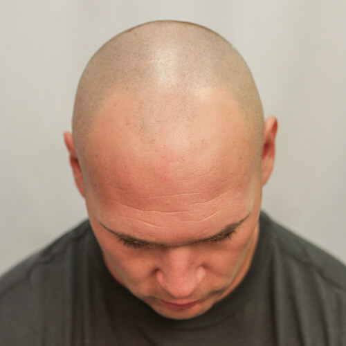Brian Urlacher Before Hair Transplant Brian Urlacher Before Hair Transplant