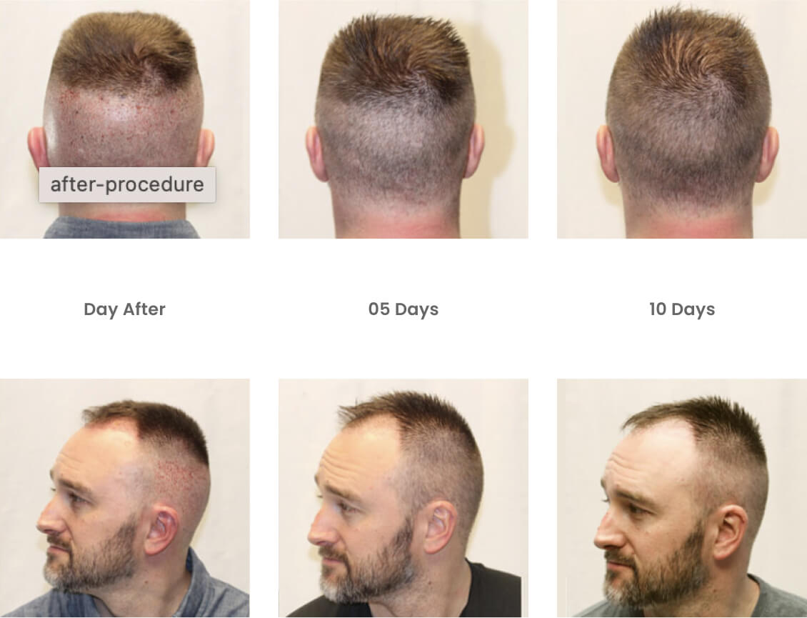 before after image (1) How long does post-op redness last after a hair transplant?