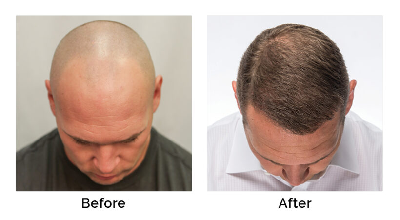 Brian Urlacher Hair Transplant Results | RESTORE Hair