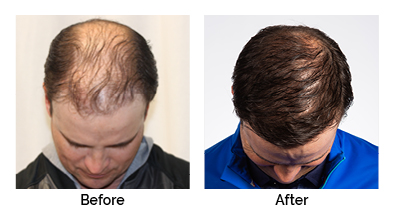 Zach Johnson Before and after Results RESTORE Hair Zach Johnson Before and after Results RESTORE Hair