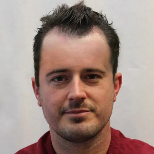 Brent L. before hair transplant