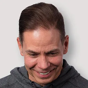 Dave S. after hair transplant