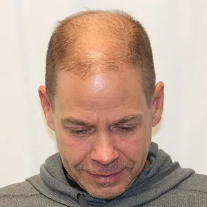 Dave S. before hair transplant