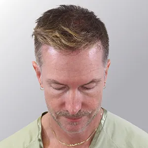 Ian M. after hair transplant