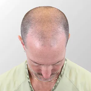 Ian M. before hair transplant