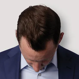 Jake W. after hair transplant