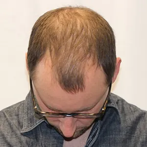 Jake W. before hair transplant