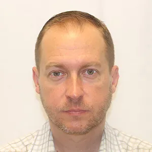 James W. before hair transplant