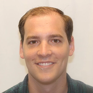 Josh K's Before Hair Transplant Results